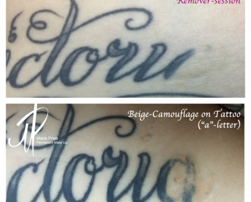Tattooentfernung