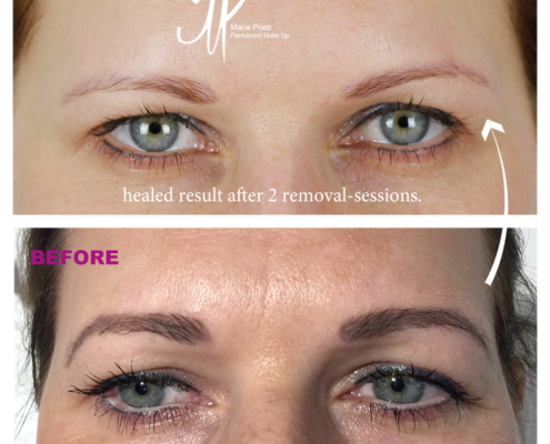 Tattooentfernung
