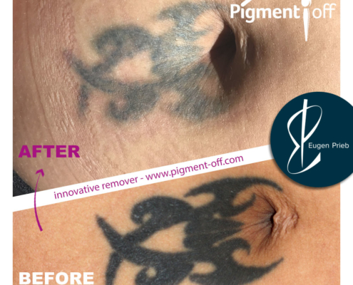 Tattooentfernung